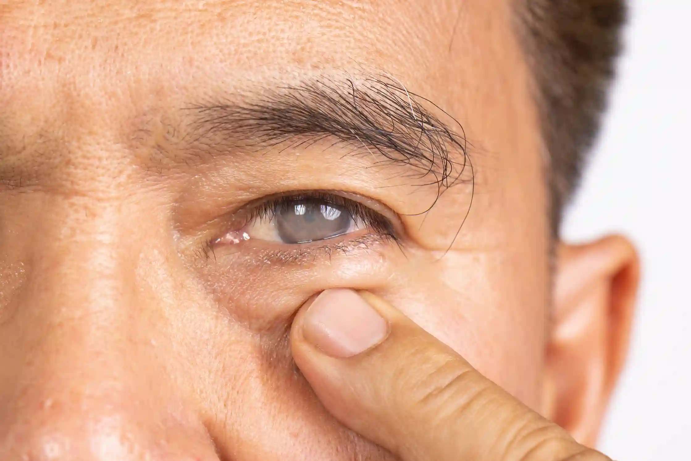 early cataracts symptoms cloudy vision